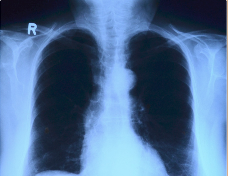 mesotelioma benigno - diagnóstico y opciones de tratamiento